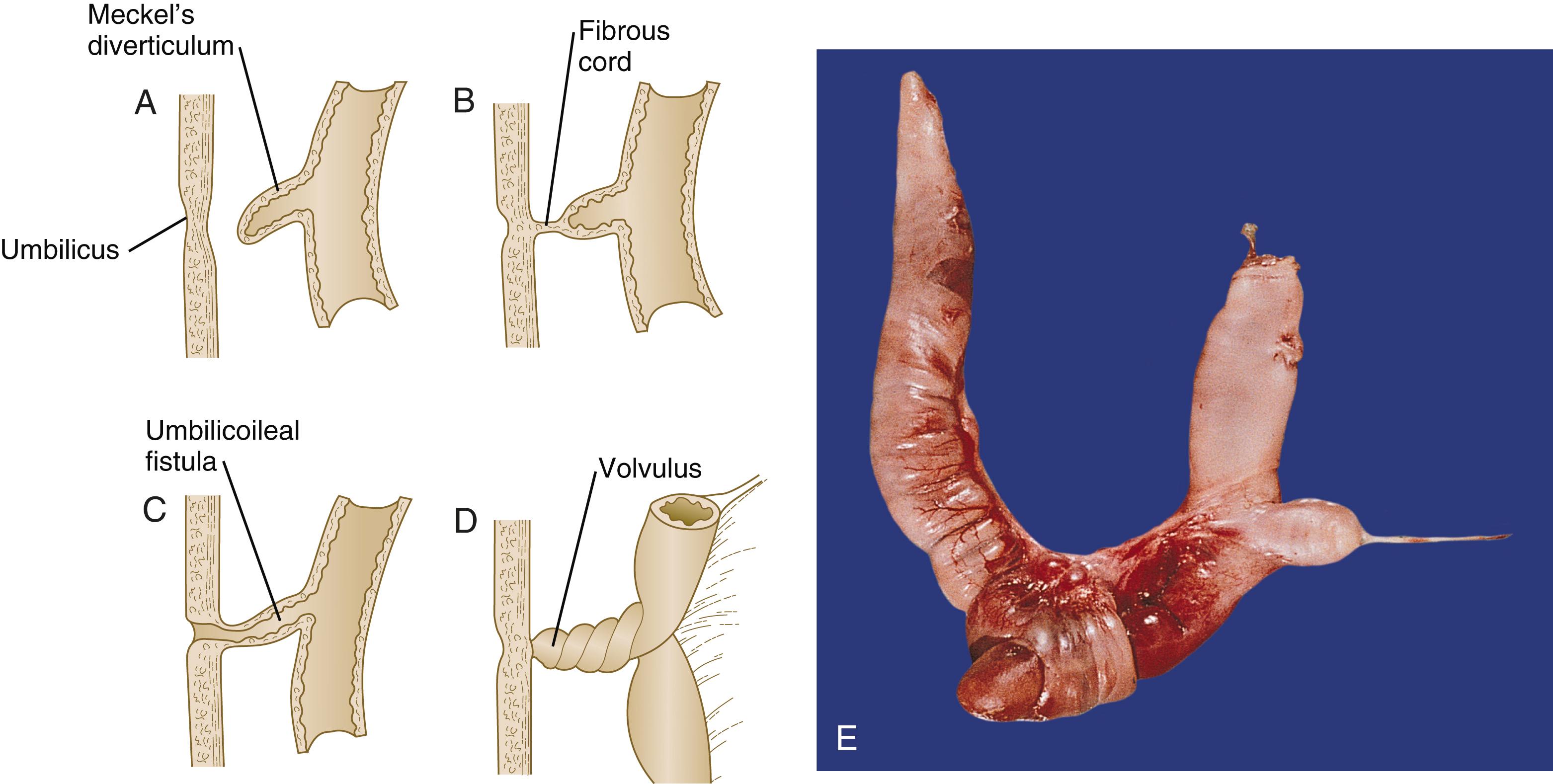 Fig. 15.16, Varieties of vitelline duct remnants.