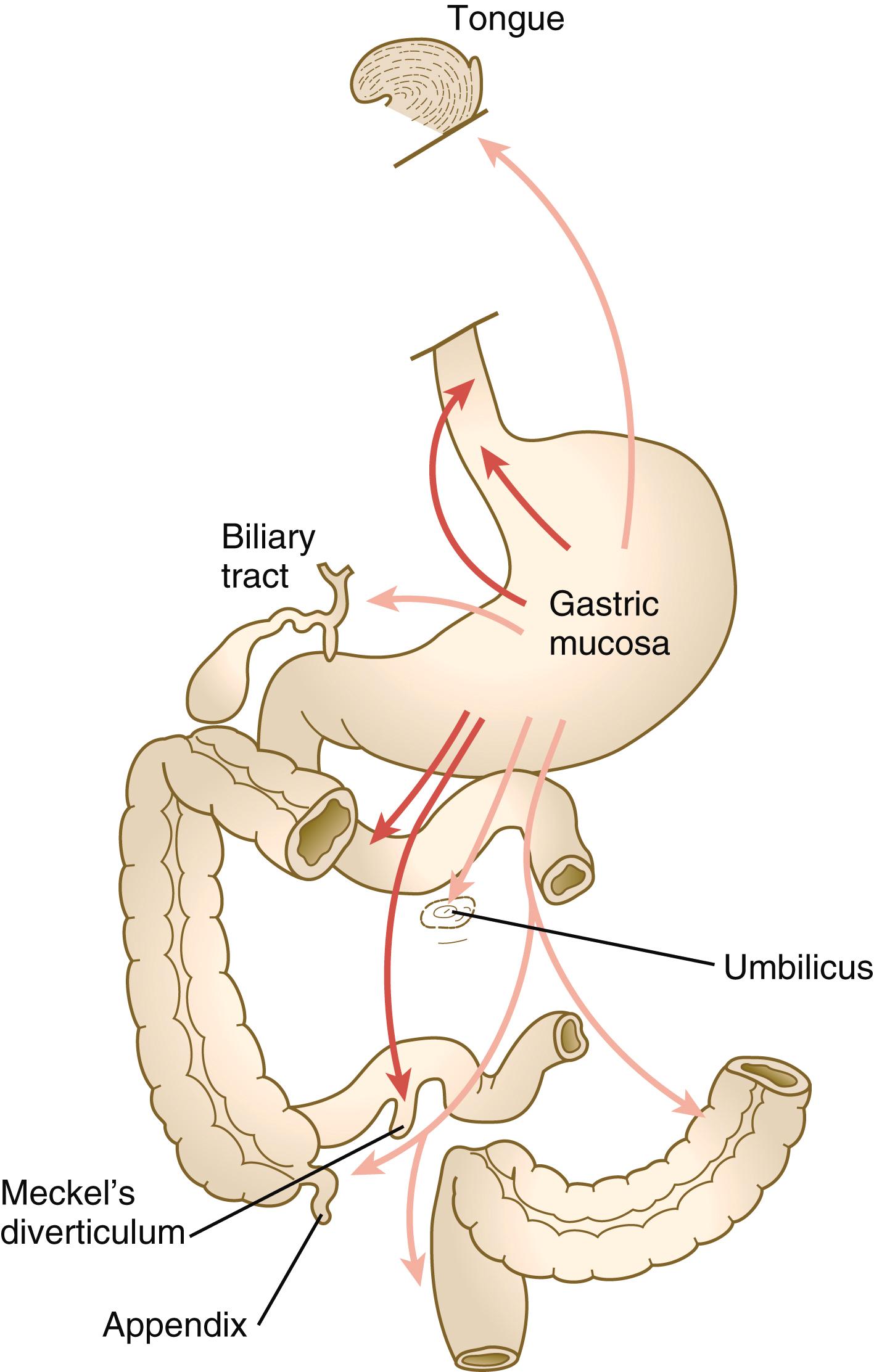 Fig. 15.10, Locations of heterotopic gastric tissue.