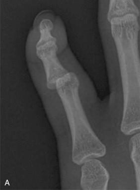 Fig. 74.8, The phalanges shown in the bayonet position on anteroposterior x-ray (A) and on lateral x-ray (B).