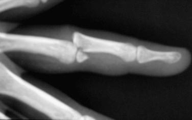 Fig. 74.9, Dorsal subluxation of the proximal interphalangeal joint with an impacted fracture at the base of the middle phalanx (P-2).