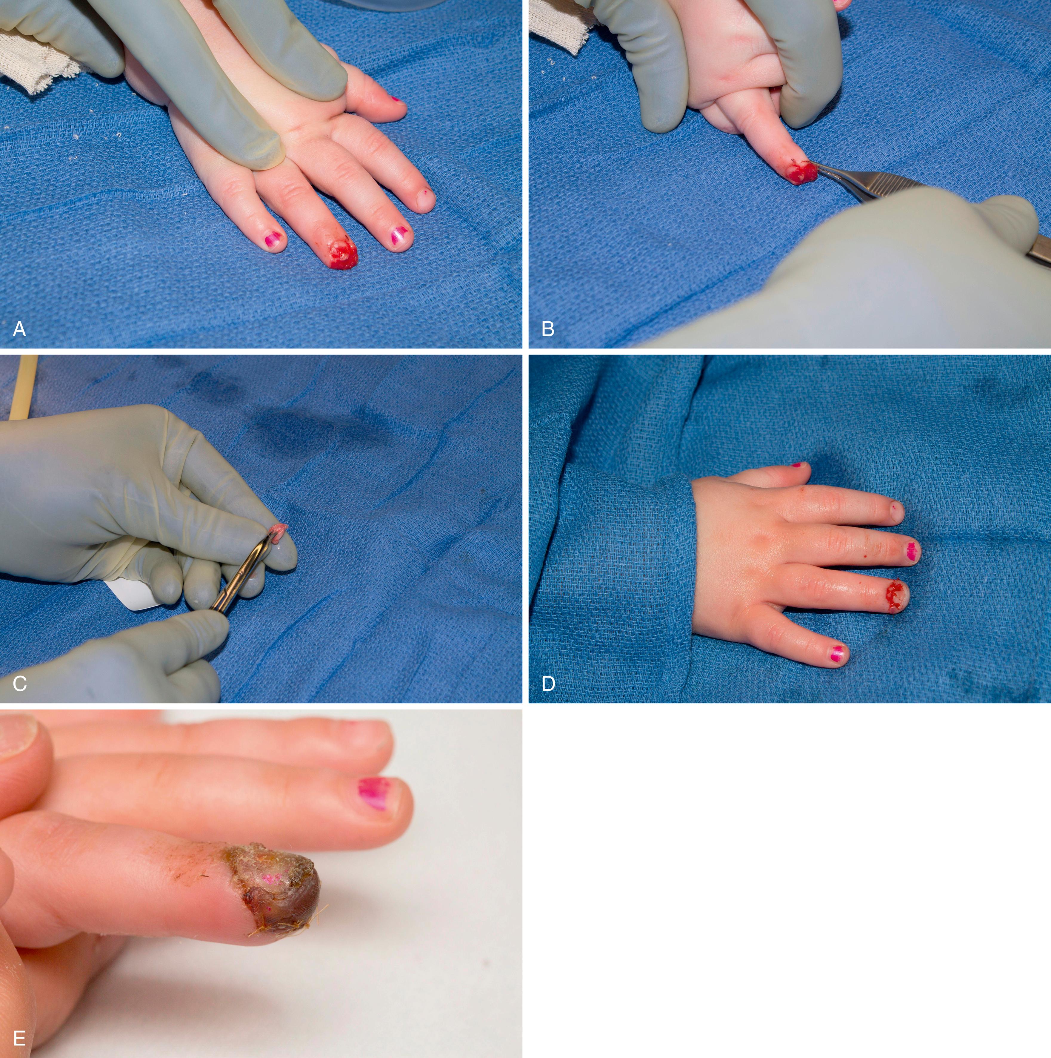 Fig. 49.2, A to E, A 6-year-old child with a tip amputation with exposed bone. The patient underwent composite graft repair with defatting of the tip. Note the appearance at 2 weeks postsurgery.