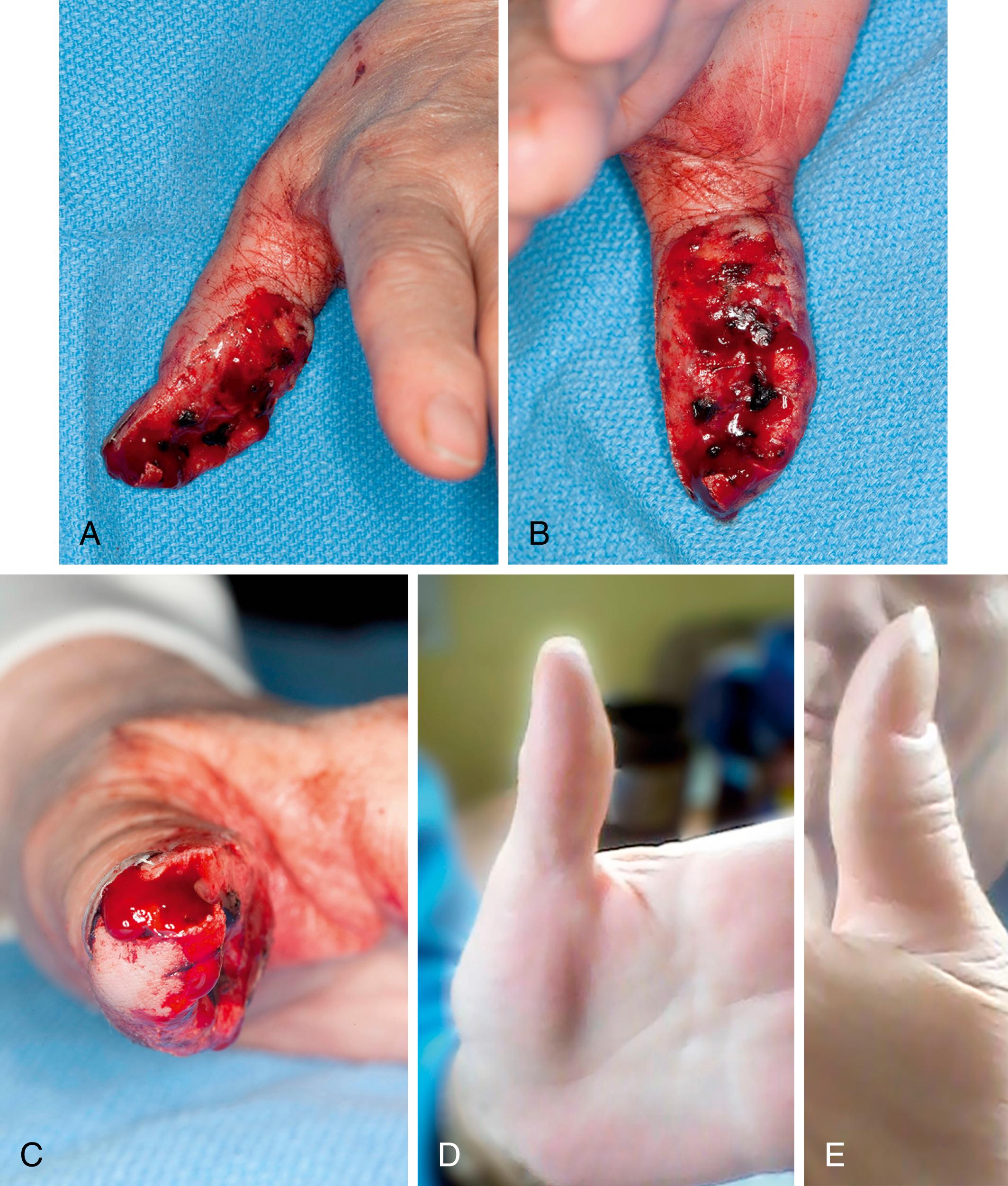 Fig. 49.3, A 74-year-old woman who sustained a degloving injury to the thumb tip that was treated with MIST treatment and dressing changes. Note the excellent esthetic result. A to C, Degloving injury to thumb. Note the loss of palmar tissue. D and E, Esthetic result of the thumb after nonoperative treatment.