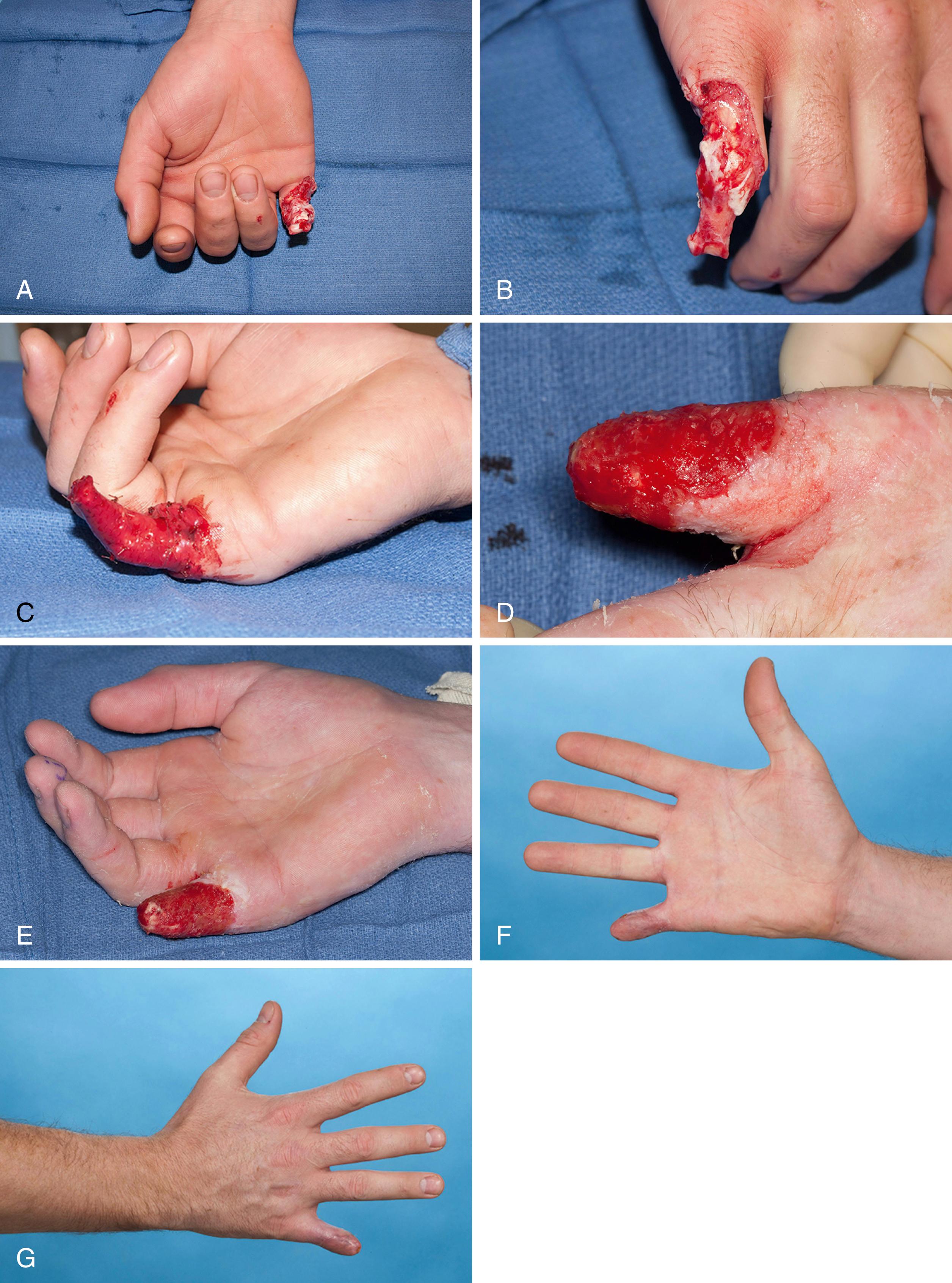 Fig. 49.4, Treatment of a patient with a ring avulsion injury with Integra and skin grafting. A, Ring avulsion injury, palmar view. B, Ring avulsion injury, dorsal view. C, Application of Integra. D, Granulating wound after Integra placement. E, Granulating bed for skin graft. Palmar (F) and dorsal (G) appearance of small finger.