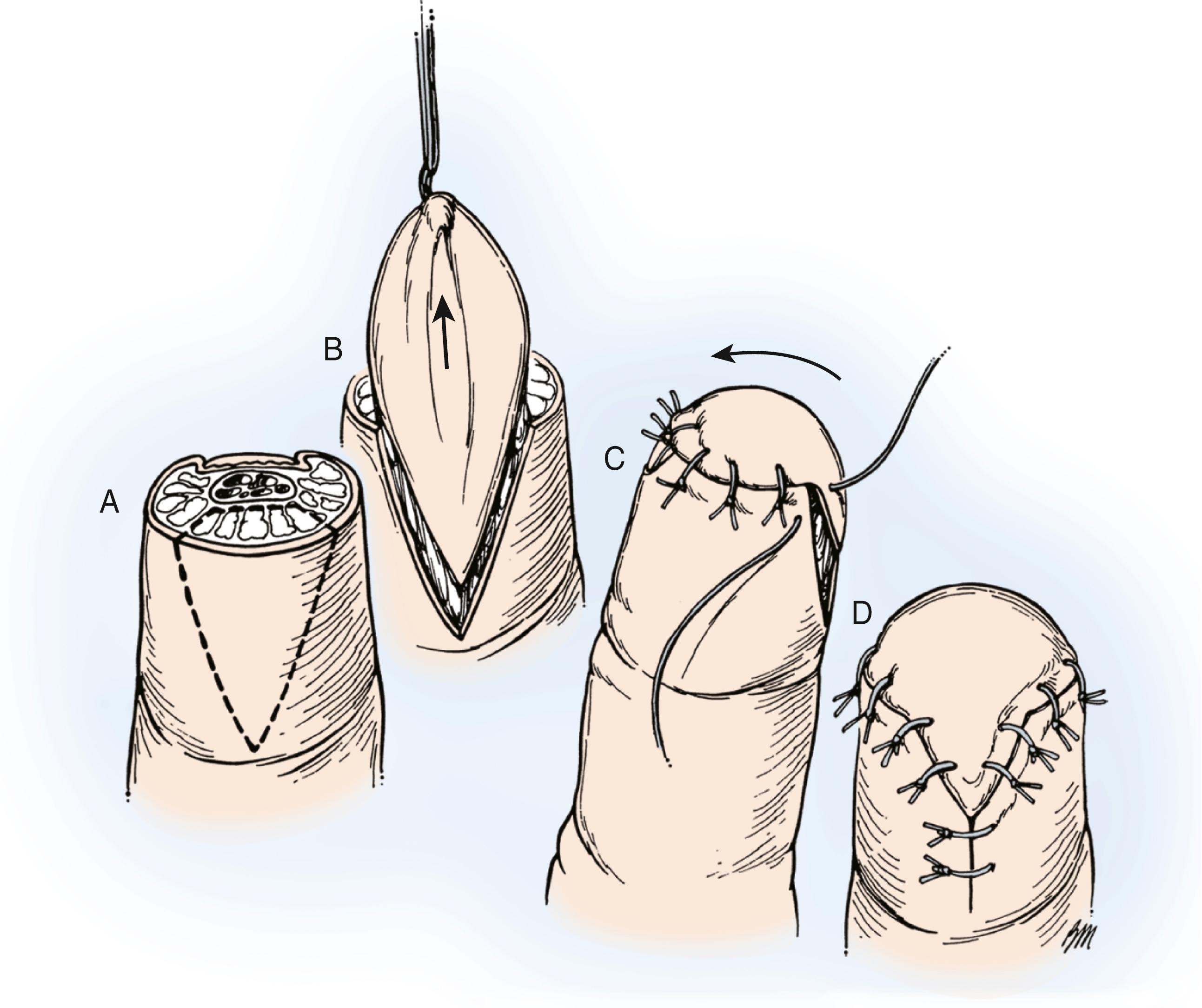 Fig. 49.5, The Atasoy-Kleinert volar “V-Y” technique is applicable to distal tip injuries with bone exposed and when the distal injury is either transverse or oblique and sloping in a dorsal proximal-to-volar distal direction. In injuries with more volar pad loss, there is usually insufficient skin for this technique to be used. A, Marking of the flap. Note that the apex is at the DIP joint crease. B, Raising and advancement of the skin flap distally. C, Closure of the flap from distal to proximal. Take care to ensure the flap is not overly tight. D, Closure of V-Y.