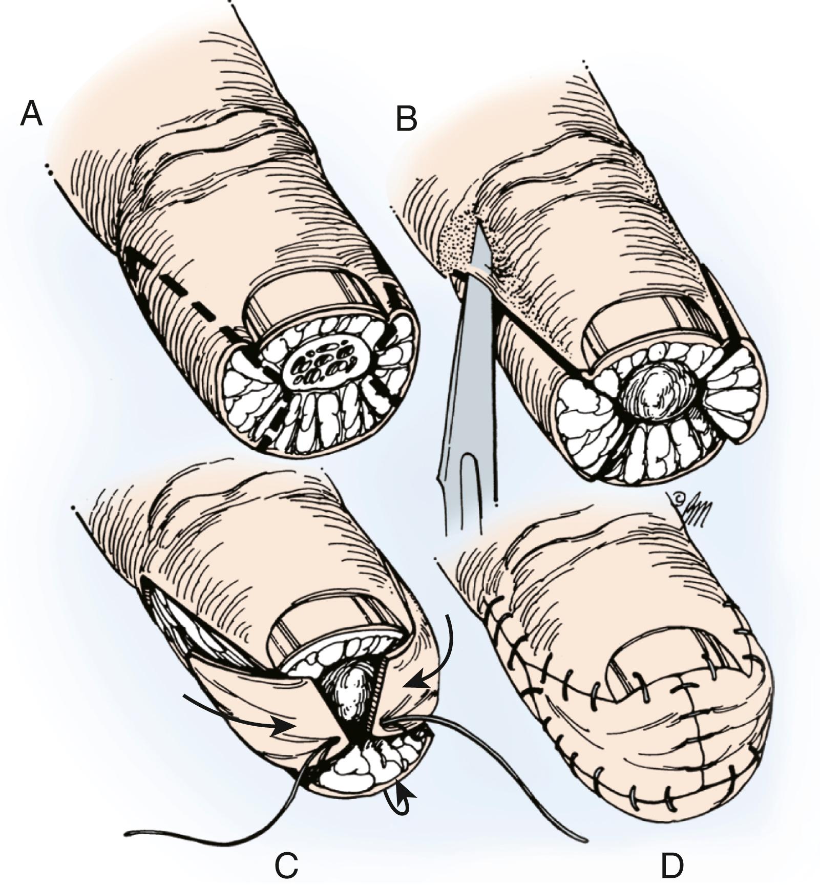 Fig. 49.6, A, Triangular flaps are marked, centered over the midlateral aspect of the finger. B, The skin is incised and fibrous septa divided, allowing mobilization of the flaps distally. C, Distal advancement of the flaps. D, The wounds are closed from distal to proximal.