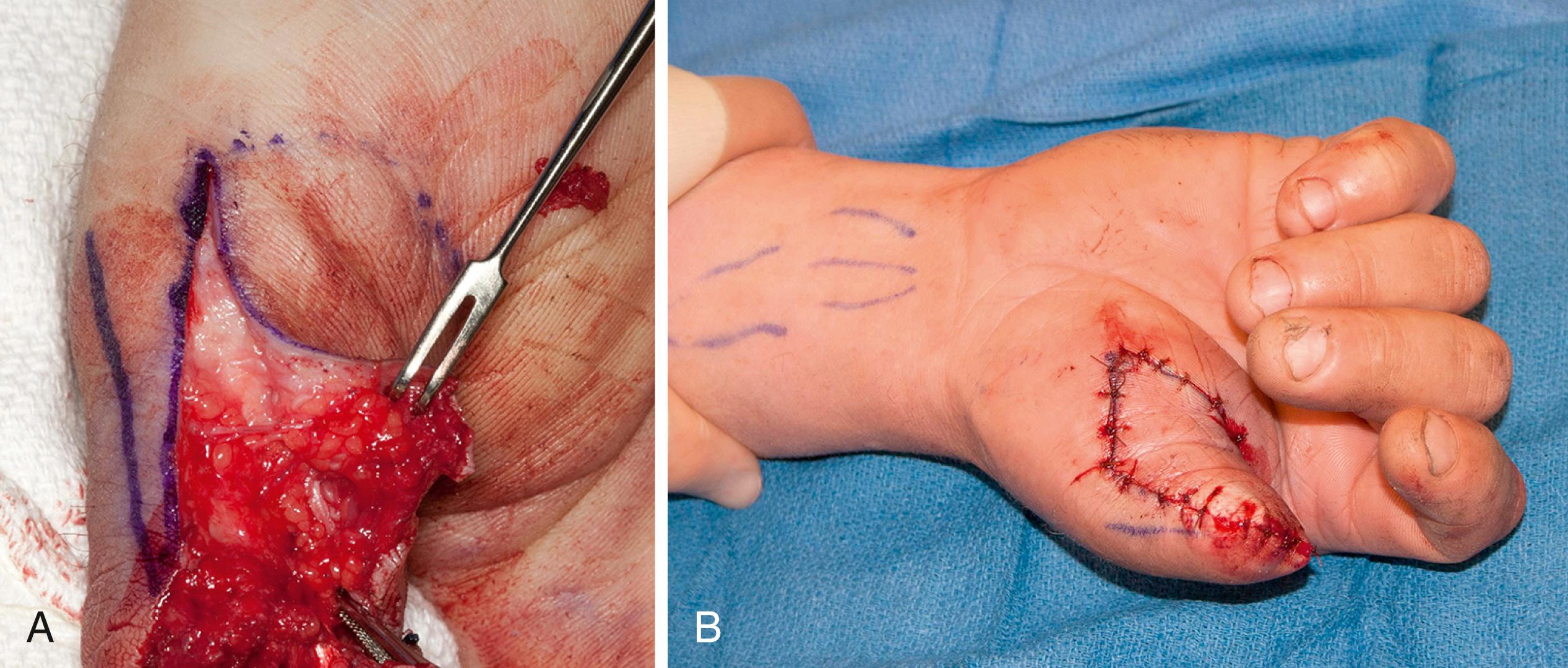 Fig. 49.7, Patient with traumatic amputation of thumb with advancement flap to preserve as much length as possible. A, Raising flap from distal to proximal with neurovascular bundle within volar flap to maintain viability. B, Bony coverage by volar lap advancement.