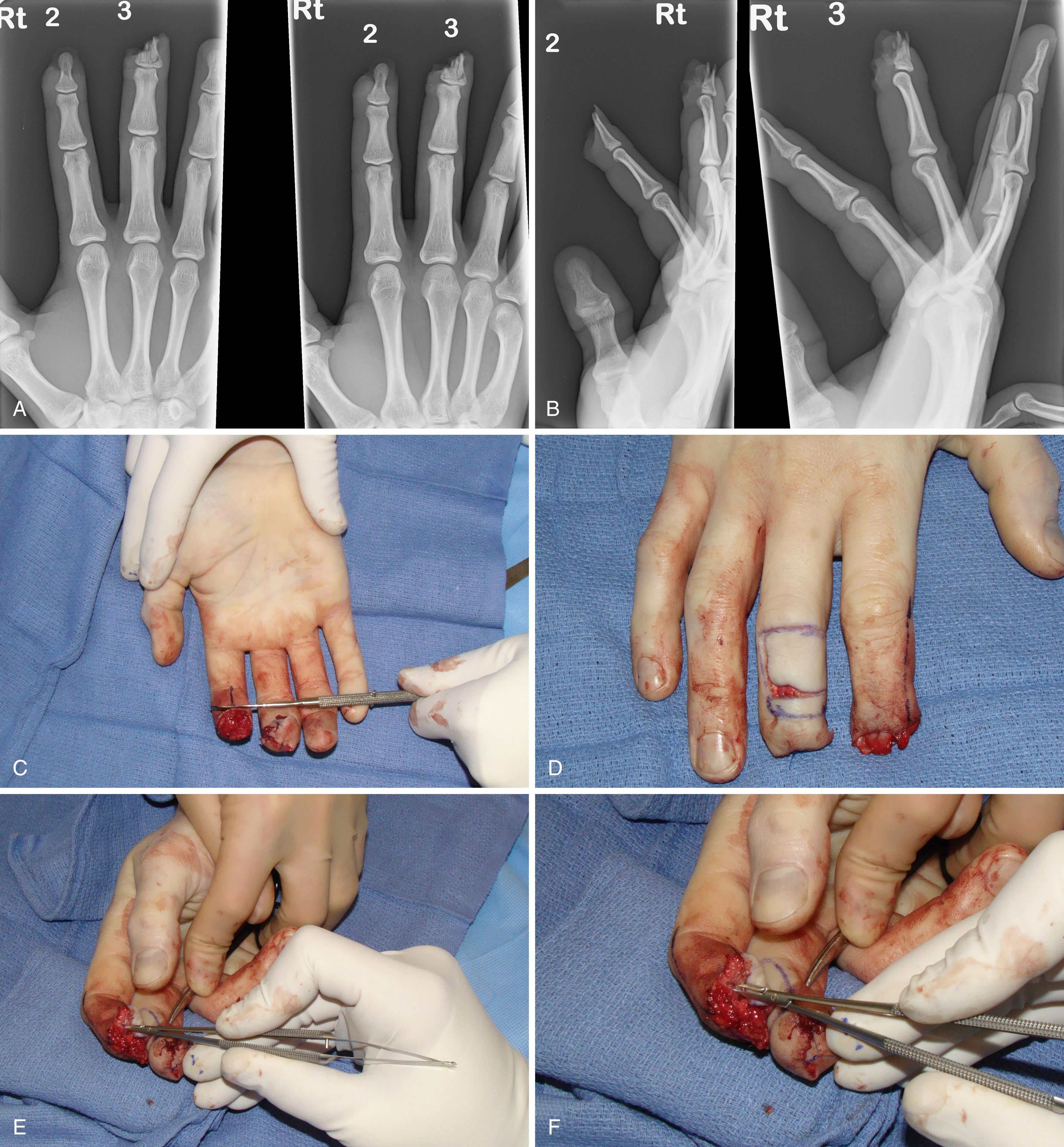 Fig. 49.8, Cross-finger flap for loss of palmar skin to index finger after crush injury to index and long fingers. A and B, Radiographs demonstrating index and middle finger tip injuries. C, Index finger tip skin loss and open wound. D to G, Radial based dorsal flap from middle finger to index finger for tip coverage with dorsal sensory nerve from ulnar/dorsal middle finger and coaptation to distal index radial digital nerve. H to J, Three month follow-up demonstrates satisfactory motion and improving radial index finger sensation.