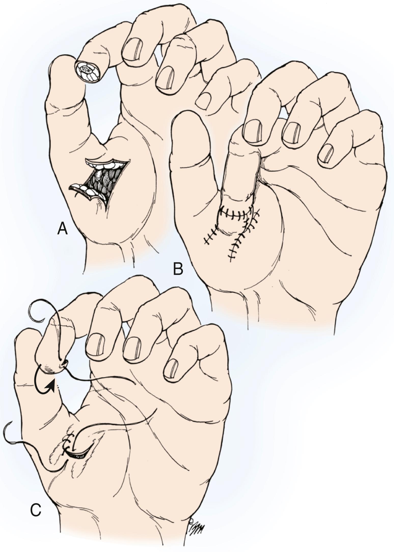 Fig. 49.9, A to C, The thenar “H”-flap as described by Smith and Albin.