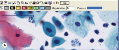 Figure 34-7, This is a real example of the effect of using an “extended focus” manipulation of the digital image. (A) The slide was scanned using a single focus plane, whereas in (B) the slide was scanned at multiple focal planes and the final image is a mixture of tiles from the best focused tile at each area on the slide. Note the improvement in the focus of the isolated cells in this field.