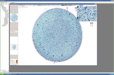 Figure 34-8, Example of a whole slide image review station screen. The primary viewing area is on the right side of the image. “Thumbnail” images for localization are shown on the left. Magnification is controlled by the buttons on the top of the screen (arrow) with the actual magnification shown in the box (double arrow), which is ×1.15 in this example. In this viewer a high-magnification “hover” window is present in the upper right corner of the viewer (triple arrow), allowing the observer a quick view of the area covered by the mouse cursor.