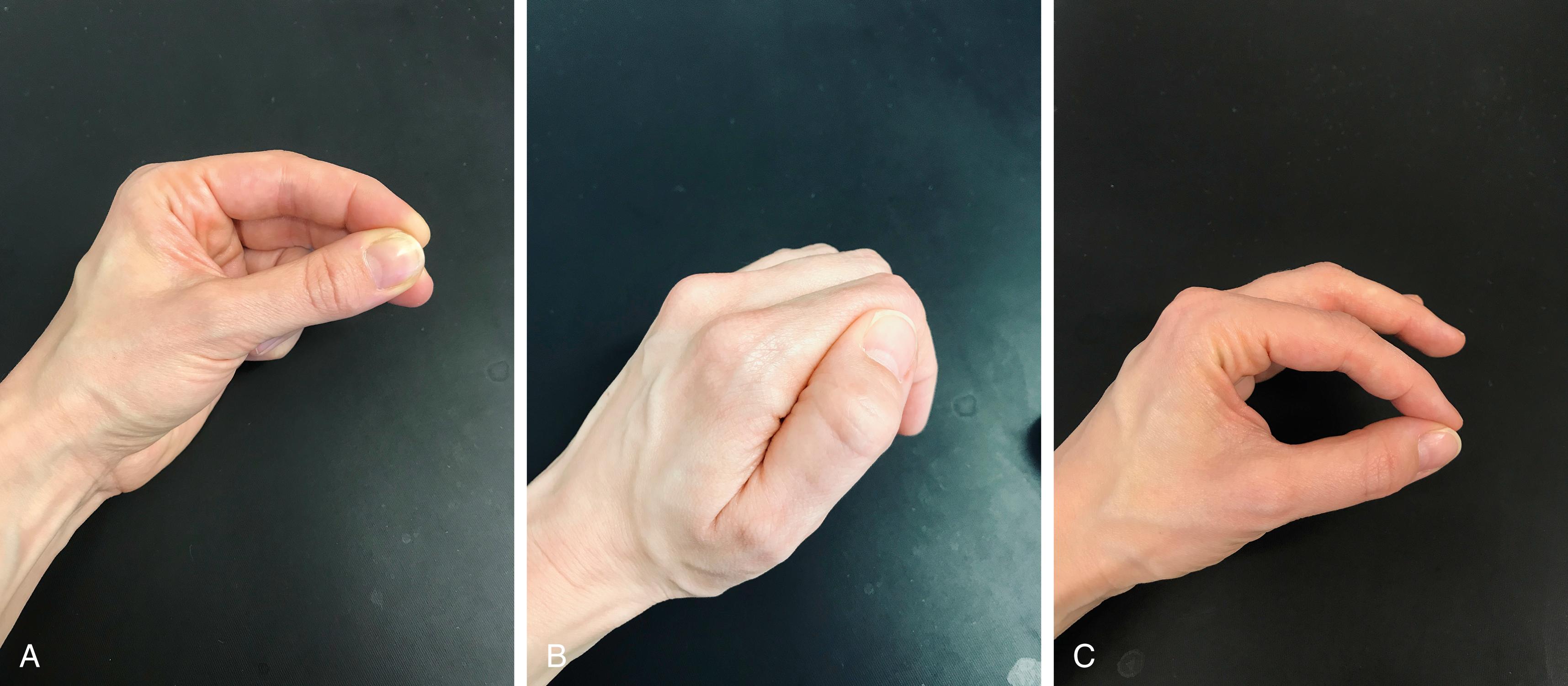 Fig. 50.1, Basic hand function. (A) Pollico-digital pinch grip and palmar digital grip. (B) Lateral key pinch, requires thumb adduction, mobile basal joint, and stable opposition post. (C) Pulp pinch, requires intrinsics for joint stabilization.