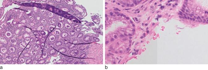 Fig. 22.4, ( a ) Focusing artifact where the scanner has been unable to acquire a well-focused image of the entire tissue due to folds. Using a glass slide a pathologist may be able to compensate for this by focusing up and down through the depth of the tissue but such compensation is not possible on a digitally acquired image. ( b ) Striping artifact caused by inconsistent illumination across the slide. The scanner may require recalibrating.