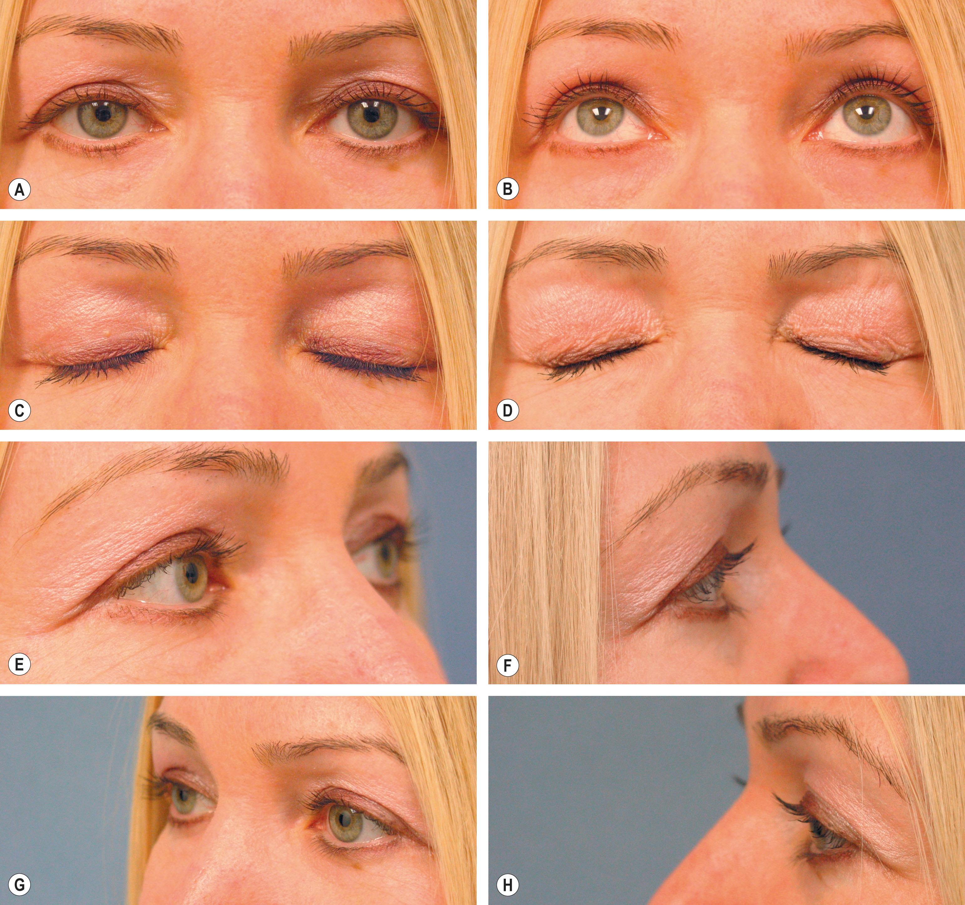 Figure 7.3, Eyes: standard views. (A) Anterior–posterior (AP). (B) AP with upward gaze. (C) AP with eyes closed gently. (D) AP with eyes closed tightly. (E) Right oblique in forward gaze. (F) Right lateral in forward gaze. (G) Left oblique in forward gaze. (H) Left lateral in forward gaze.