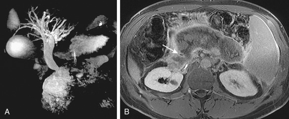 Figure 52-1, Necrotizing pancreatitis. A, magnetic resonance cholangiopancreatography (maximal intensity projection) image demonstrates marked intrahepatic and extrahepatic duct dilatation to the level of the pancreas, which shows as high T2 signal intensity and is amorphous. B, Postcontrast axial T1-weighted image shows a nonenhancing necrotic mass replacing most of the pancreas and compressing the common bile duct (arrow).