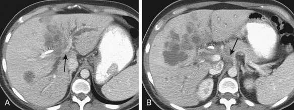 Figure 52-11, Advanced hilar cholangiocarcinoma (Klatskin's tumor) with hepatic metastases on postcontrast axial computed tomography images of the abdomen. The tumor is invading the hepatic parenchyma, the portal vein ( arrow, A ), and the celiac axis ( arrow, B ).