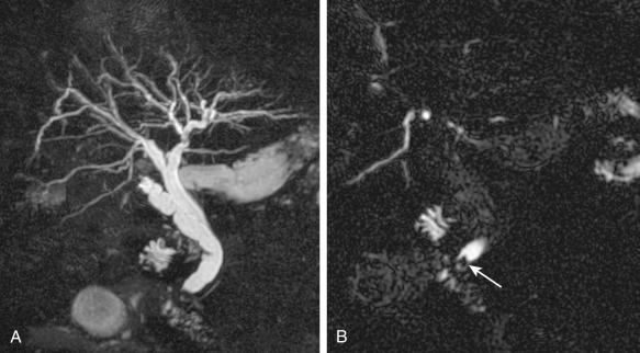 Figure 52-12, Magnetic resonance cholangiopancreatography of choledocholithiasis. A, Maximum intensity projection image shows intrahepatic and extrahepatic bile duct dilatation and suggests narrowing at the ampulla. B, Source image reveals that, in fact, a small stone (arrow) in the distal common bile duct is the cause of the bile duct dilatation.