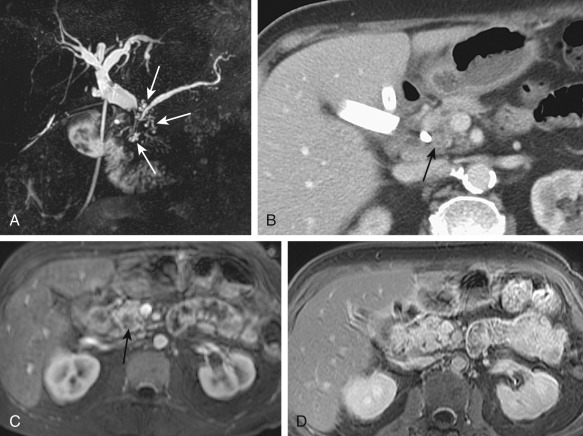 Figure 52-13, Pancreatic head adenocarcinoma. A, Magnetic resonance cholangiopancreatography shows double duct sign and dilatation of pancreatic duct side branches (arrows), suggesting adenocarcinoma of the pancreatic head. B, Post–intravenous contrast computed tomography shows the carcinoma as a low-density lesion (arrow). C, However, the mass is most conspicuous in the arterial phase postcontrast T1-weighted image as a hypointense mass (arrow). D, It is difficult to visualize in the delayed phase.