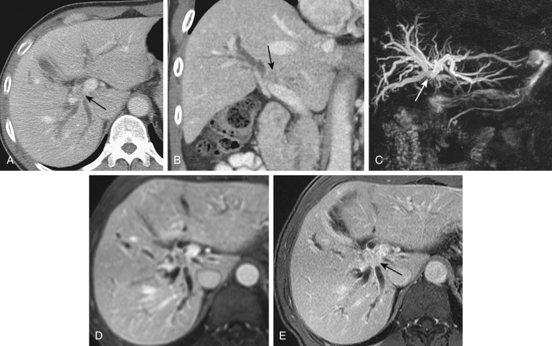 Figure 52-14, Klatskin's tumor. Axial (A) and coronal (B) postcontrast computed tomography images show low-density tumor (arrows) at the confluence of the right and left hepatic ducts suggestive of cholangiocarcinoma (Klatskin's tumor). Magnetic resonance cholangiopancreatography maximum intensity projection (C), axial early arterial phase (D), and delayed high-resolution (E) magnetic resonance images show abrupt transition point of bile duct caliber ( arrow, C ) at the confluence of the right and left hepatic ducts, where the cholangiocarcinoma shows characteristic delayed enhancement ( arrow, E ).