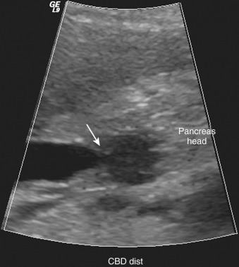 Figure 52-15, Ultrasound-detected pancreatic mass in a patient with known non–small cell lung carcinoma and biliary dilatation. Longitudinal view of the common bile duct shows abrupt termination of a dilated duct secondary to a hypoechoic pancreatic head mass (arrow), presumably a lung metastasis or primary pancreatic adenocarcinoma. The patient had an iodine contrast allergy, and this lesion was not visible on noncontrast computed tomography.