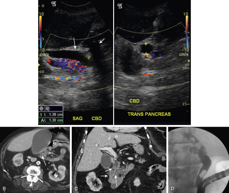 Figure 52-16, A, Ultrasound image showing extrahepatic bile duct dilatation (long vertical arrow). The distal common duct in the head of the pancreas is not visualized owing to shadowing from overlying bowel gas (short arrow). Computed tomography (CT) reveals the cause of duct dilatation, choledocholithiasis. B, Axial postcontrast CT scan shows a stone (arrow), slightly denser than bile, in the extrahepatic bile duct within the head of the pancreas. The rim of surrounding hypodense bile creates a “target” appearance. C, Coronal reformatted image shows that there are multiple stones (short arrows ) in the distal common bile duct and a dilated pancreatic duct (long arrow). D, Endoscopic retrograde cholangiopancreatography also shows multiple stones in the common duct. CBD, Common bile duct; SAG, sagittal.