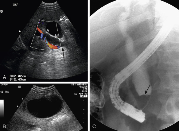 Figure 52-17, Ampullary adenocarcinoma. Ultrasonography demonstrates bile duct (long arrow) and gallbladder (short arrow) dilatation. The distal common bile duct was not well visualized. The patient was jaundiced, and the gallbladder was palpable; Courvoisier's law states that the cause is not gallstones. C, Endoscopic retrograde cholangiopancreatography shows an abrupt cutoff at the ampulla by an eccentric mass lesion (arrow) that proved to be ampullary carcinoma.