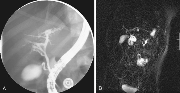 Figure 52-18, Caroli's disease with multiple areas of focal intrahepatic bile duct dilatation. A, Endoscopic retrograde cholangiopancreatography. B, Magnetic resonance cholangiopancreatography.