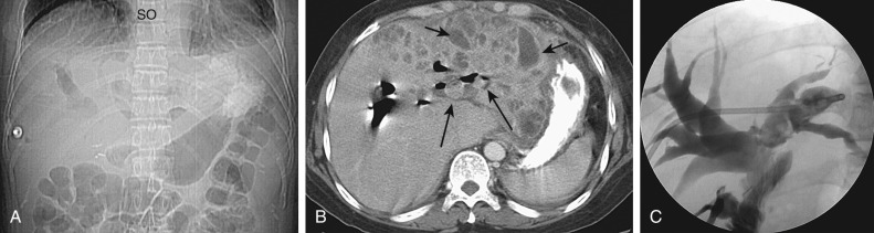 Figure 52-19, Recurrent pyogenic cholangitis. A, Scout film shows marked fusiform dilatation of the intrahepatic bile ducts with pneumobilia. B, Postcontrast axial computed tomography of the abdomen shows intrahepatic bile duct stones (long arrows ) and abscess formation (short arrows). C, Injection of an abscess drainage catheter 5 years later shows communication of the liver abscess with markedly dilated bile ducts. Debris is seen within the left-sided ducts. No significant stricture of the biliary-enteric anastomosis is seen at this time.