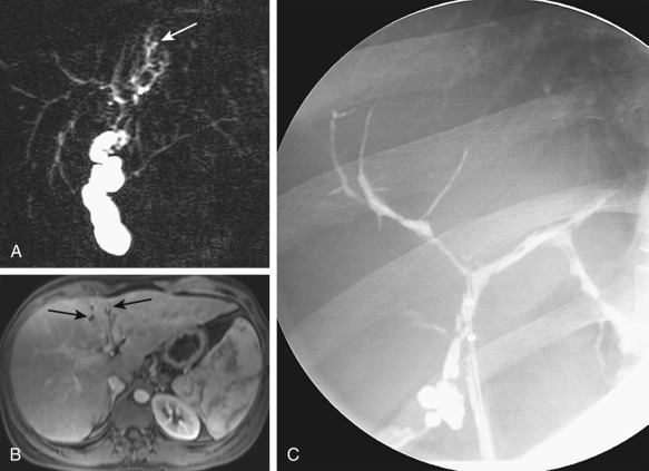 Figure 52-20, Sclerosing cholangitis with strictures and segmental biliary dilatation (arrows) in segment IV. A, Magnetic resonance cholangiopancreatography. B, Postcontrast T1-weighted magnetic resonance image. C, Strictures are best seen on endoscopic retrograde cholangiopancreatography (ERCP), but the dilated ducts are not filled on ERCP.