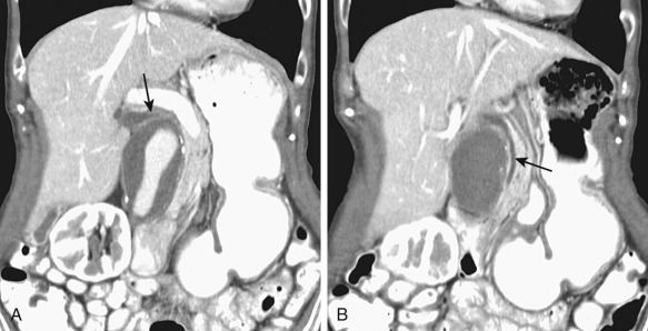 Figure 52-2, Mild biliary dilatation secondary to extrinsic compression of the common bile duct by an abdominal aortic aneurysm. A 66-year-old woman presented with weight loss and elevated alkaline phosphatase level. A and B, Coronal reformatted computed tomography images show mild compression of the bile duct (arrows) by a 4.8-cm infrarenal abdominal aortic aneurysm.