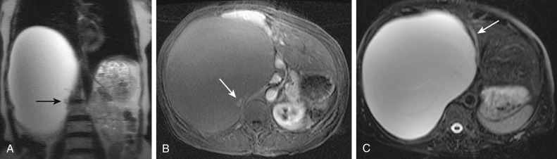 Figure 52-3, Biliary cystadenoma causing mild intrahepatic bile duct dilatation as a result of extrinsic compression. Coronal single-shot fast spin echo (A), postcontrast axial flexible appearance modeling environment (B), and axial T2-weighted fast spin echo (C) magnetic resonance images show a large cystic lesion with enhancing papillary projections ( arrows, A and B ), causing mild intrahepatic bile duct dilatation ( arrow, C ).