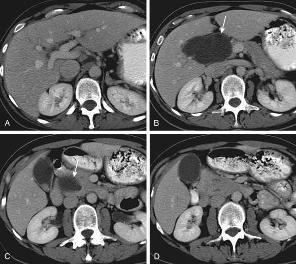 Figure 52-4, A to D, Postcontrast axial computed tomography sections of the abdomen show a type 1 choledochal cyst (arrow). A stone is noted within the gallbladder.