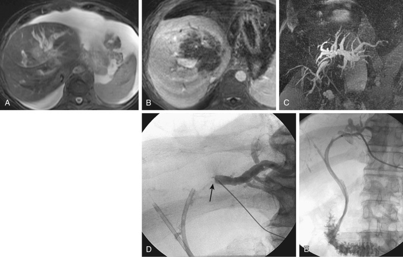 Figure 52-5, Post–liver transplant lymphoproliferative disorder. Axial T2 (A), postcontrast T1 (B), and magnetic resonance cholangiopancreatography maximum intensity projection (C) images show a large irregular mass causing left lobe intrahepatic bile duct dilatation. Percutaneous transhepatic cholangiogram (D) via puncture of a dilated left-sided duct shows an abrupt transition point because of the tumor (arrow). E, An 8-French internal-external biliary catheter has been positioned through the tight stenosis.