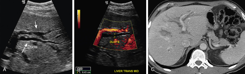 Figure 52-6, Intrahepatic duct dilatation. A, Transverse ultrasound image of the left lobe of the liver shows a dilated bile duct (long arrow) posterior to a portal vein branch (short arrow). B, Color Doppler ultrasound image shows flow within the portal vein branch. C, Computed tomography image at the same axial level.