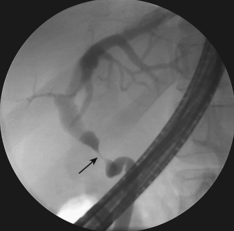 Figure 52-7, Endoscopic retrograde cholangiopancreatography shows a benign postoperative stricture (arrow) 2 months after liver transplant with end-to-end bile duct anastomosis.