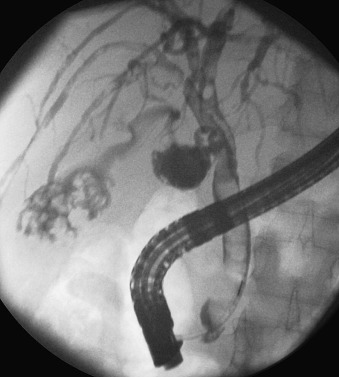 Figure 52-8, Endoscopic retrograde cholangiopancreatography shows multiple filling defects in the common duct, a combination of stones and hemorrhage. Multiple stones are seen within the gallbladder.