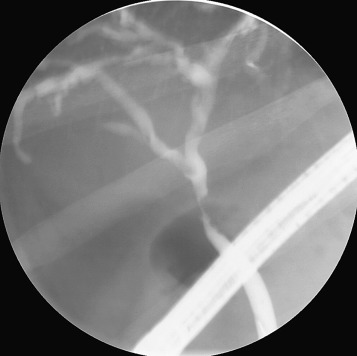 Figure 52-9, Malignant-appearing stricture of cholangiocarcinoma that has an irregular contour is asymmetric and has an abrupt transition.