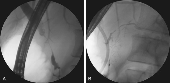 Figure 52-10, Inflammatory bile duct stricture in autoimmune pancreatitis. Long, smooth, benign-appearing stricture (A) involving the common duct, with multiple pancreatic duct strictures (B). Three weeks later (not shown) there was dramatic improvement after corticosteroid therapy, balloon dilatation, and stenting of the common bile duct stricture.