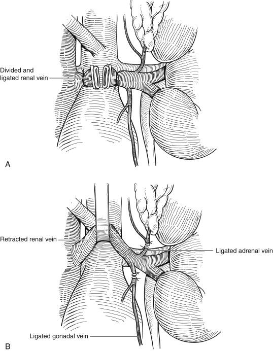 Figure 23-1, For improved exposure of the aortic neck, the left renal vein can either be ( A ) divided or ( B ) extensively mobilized, with ligation and division of the adrenal vein superiorly and the gonadal vein inferiorly.