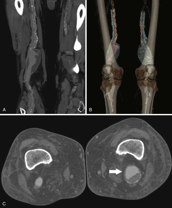 Figure 46-1, A, Multiplanar reformatted computed tomography angiogram demonstrating the size and extent of a large popliteal aneurysm. B, Surface-shaded computed tomography representation of bilateral aneurysms. Blood flow is modeled in red and thrombus in green. The left popliteal aneurysm is thombosed. C, Axial computed tomography angiogram demonstrating smaller, bilateral aneurysms with thrombus.