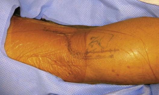 Figure 46-2, Orientation of the posterior lazy S incision. The patient’s left leg is pictured, with the calf to the right of the photograph.