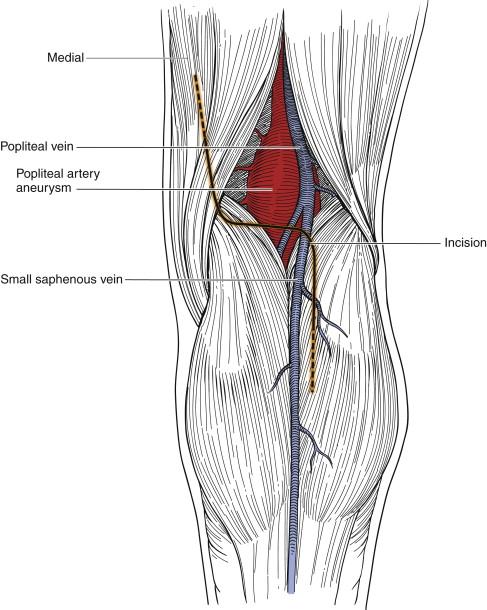 Figure 46-3, Incision for a posterior approach to the popliteal fossa.