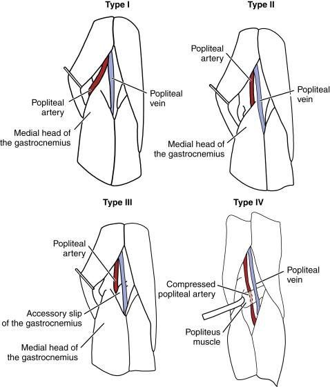 Figure 47-1, Types of popliteal artery entrapment syndrome.