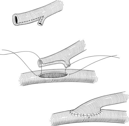 Figure 45-1, The inflow end of the reversed great saphenous vein graft can be tailored to provide a wide anastomosis by preserving a side branch that is then incorporated into the anastomosis. The vein is incised in line with the lumen of the side branch. Potts scissors are used to hook into the side branch, opening it as the terminal portion of the spatulated end of the graft, producing a flange on the heel of the graft.