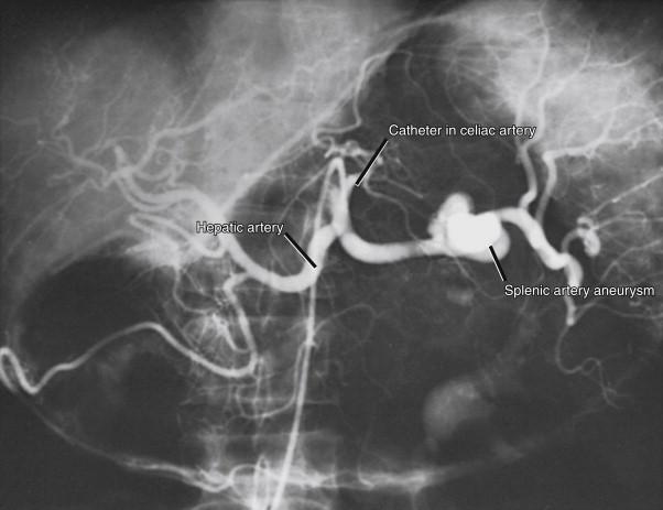 Figure 42-2, Celiac artery injection revealing the typical location of a splenic artery aneurysm in the midsplenic artery. The hepatic artery and the catheter in the celiac artery are clearly visualized.