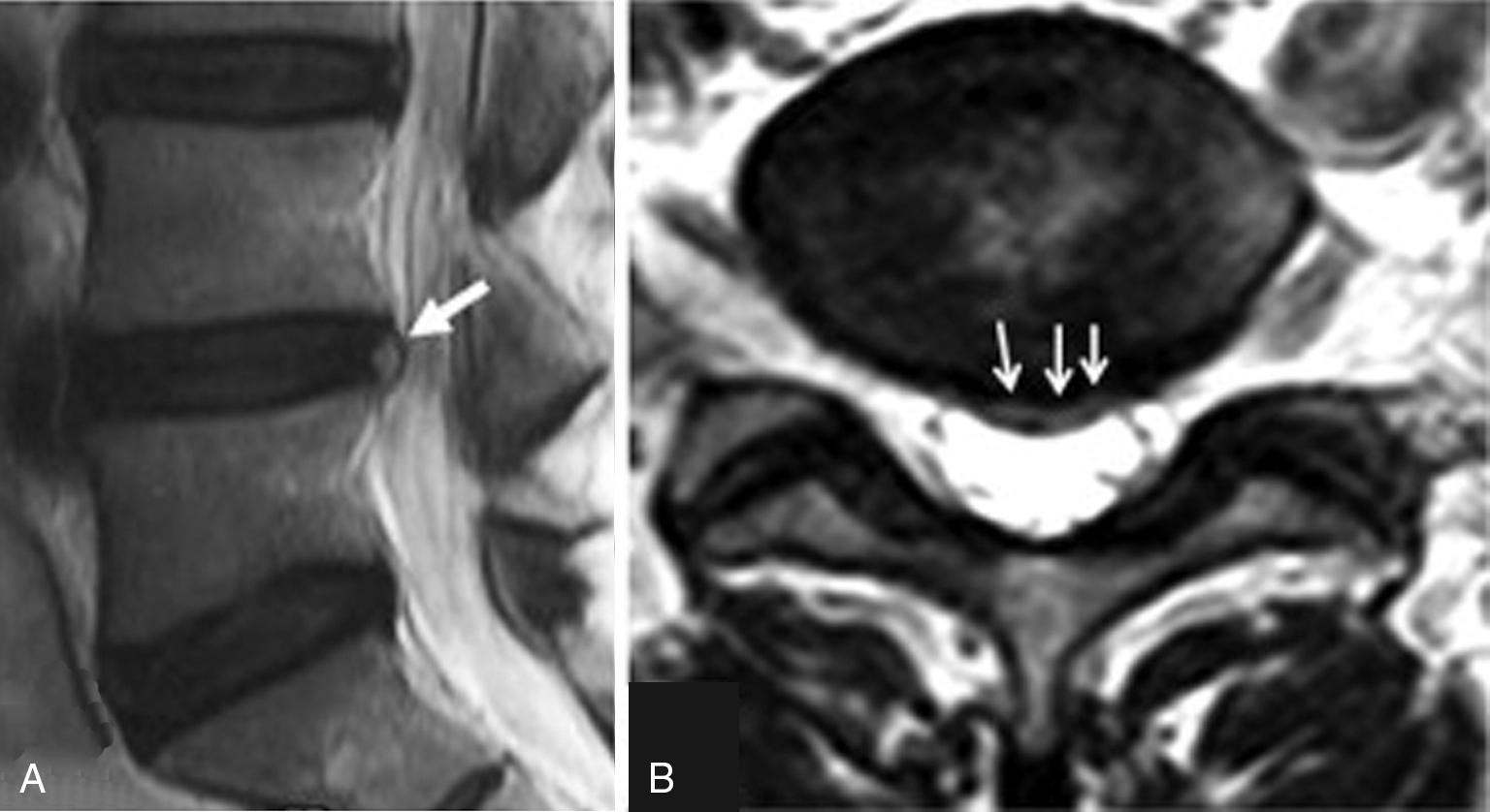 Fig. 48.1, High-intensity zone (HIZ).