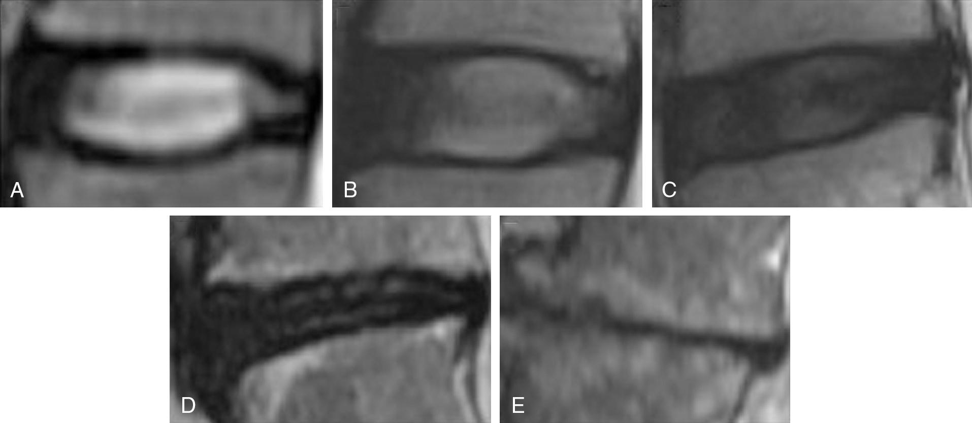 Fig. 48.2, The five Pfirrmann magnetic resonance classification grades of lumbar intervertebral disc degeneration.