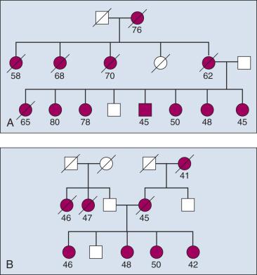 Figure 21.7, Two theoretical breast cancer families. Age at diagnosis is indicated below the symbol; males are indicated by squares, and females by circles. (A) The family has many members with breast cancer, but some were given diagnoses relatively early in life (younger than 50 years), whereas others were much older at diagnosis (older than 70 years). The usefulness of this family for genetic mapping studies is therefore limiting because it likely contains individuals with both sporadic and hereditary breast cancer. (B) All individuals were affected at an early age, but breast cancer, caused by mutations in either the same or different genes, is present on both sides of the family. Because there is no way to distinguish the number of mutant genes, a priori the usefulness of this family for a genome-wide scan is also somewhat limited.