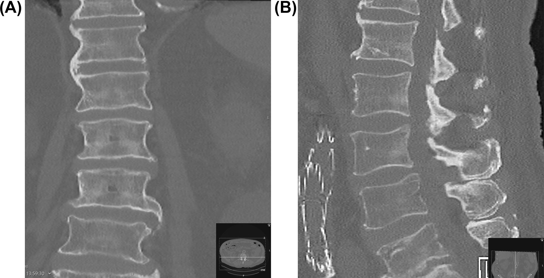 Figure 7.1, (A) Coronal and (B) sagittal CT images of the thoracolumbar spine of an 85-year-old patient demonstrating variable degrees of endplate osteophytes.