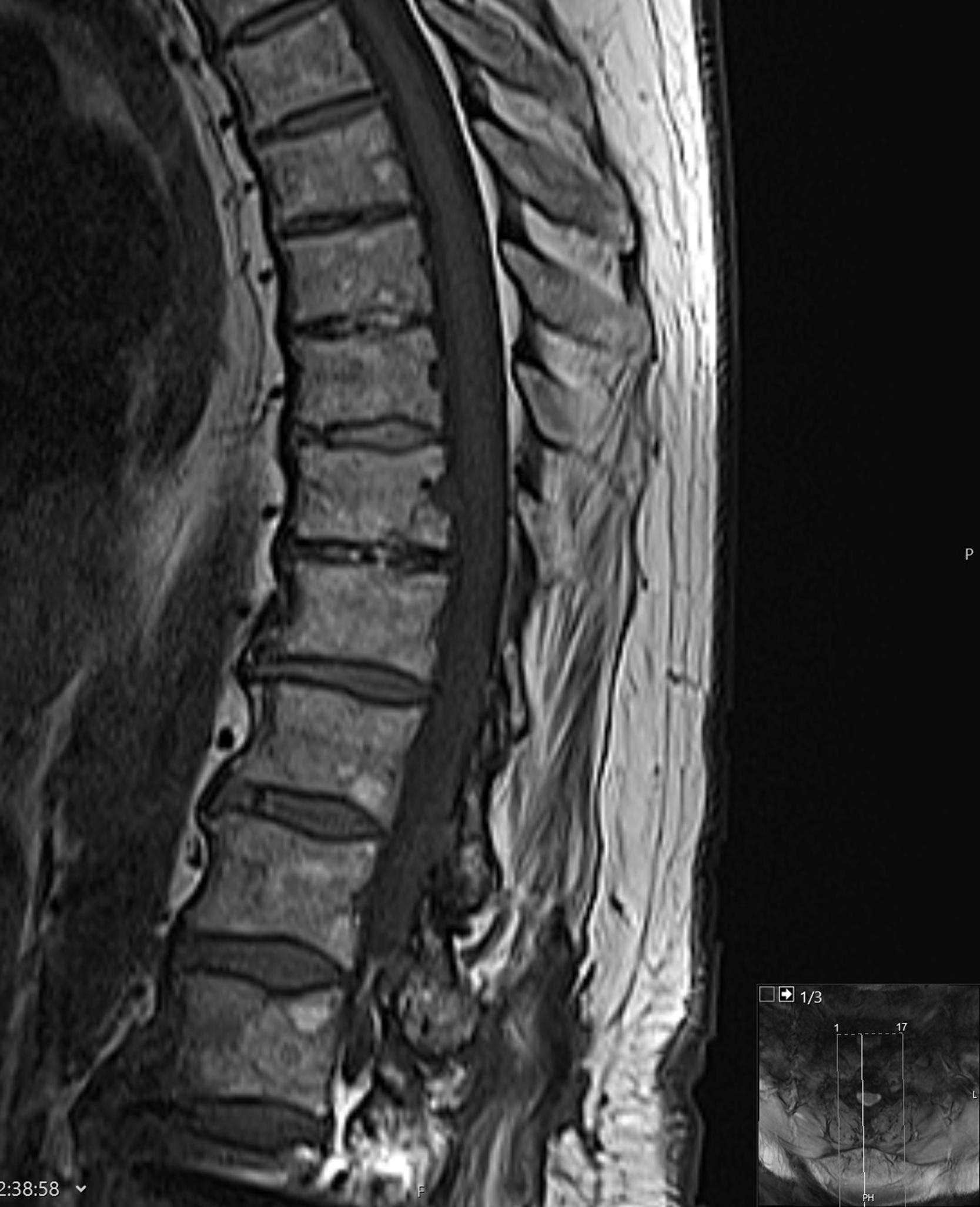 Figure 7.2, Sagittal T1-weighted MRI of the thoracolumbar spine of a 78-year-old patient demonstrating variable degrees of endplate osteophytes and disc dehydration with loss of disc height.