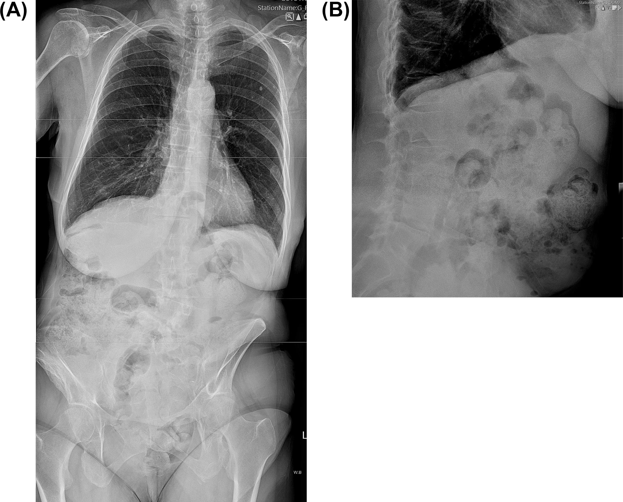 Figure 7.3, (A) Anteroposterior and (B) lateral plain radiographs of the thoracolumbar spine of a 70-year-old patient with scoliosis demonstrating variable degrees of endplate osteophytes and intervertebral disc loss of height as well as florid facet joint arthropathy.